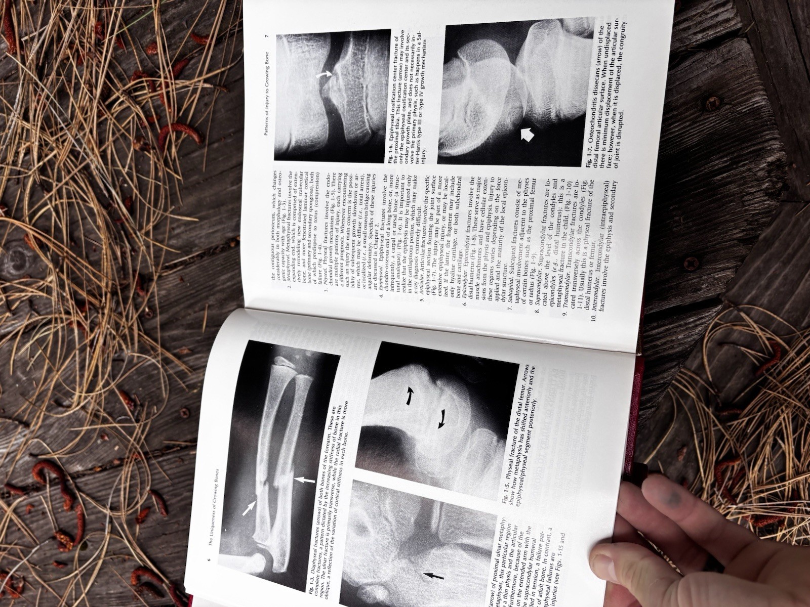 Rockwood Fractures in Adults & Children 2nd Ed Complete 3 Vol Set HC Orthopedic