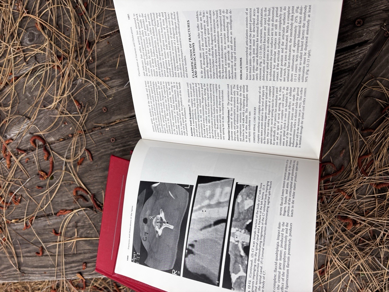 Rockwood Fractures in Adults & Children 2nd Ed Complete 3 Vol Set HC Orthopedic