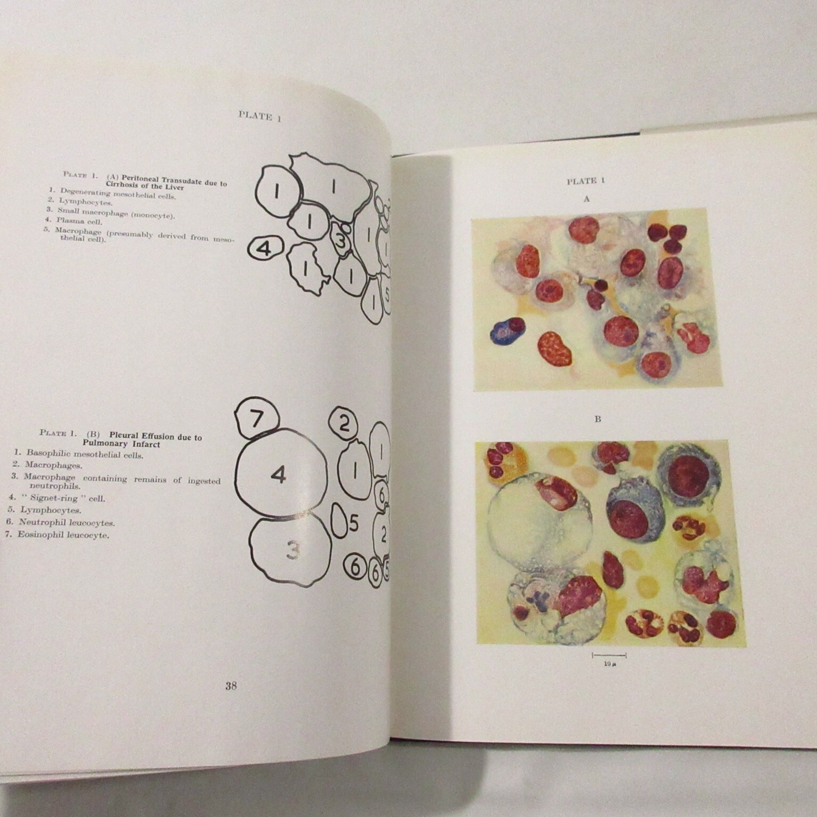 Vintage Medical Book Cancer Pathology Cytology of Effusions Spriggs Color Plates