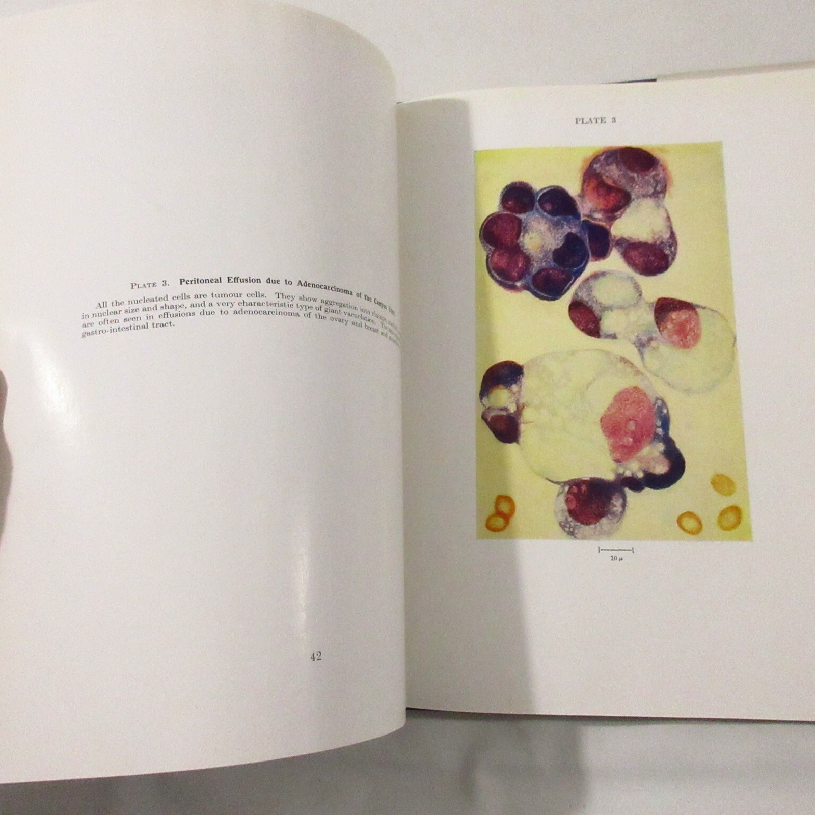 Vintage Medical Book Cancer Pathology Cytology of Effusions Spriggs Color Plates