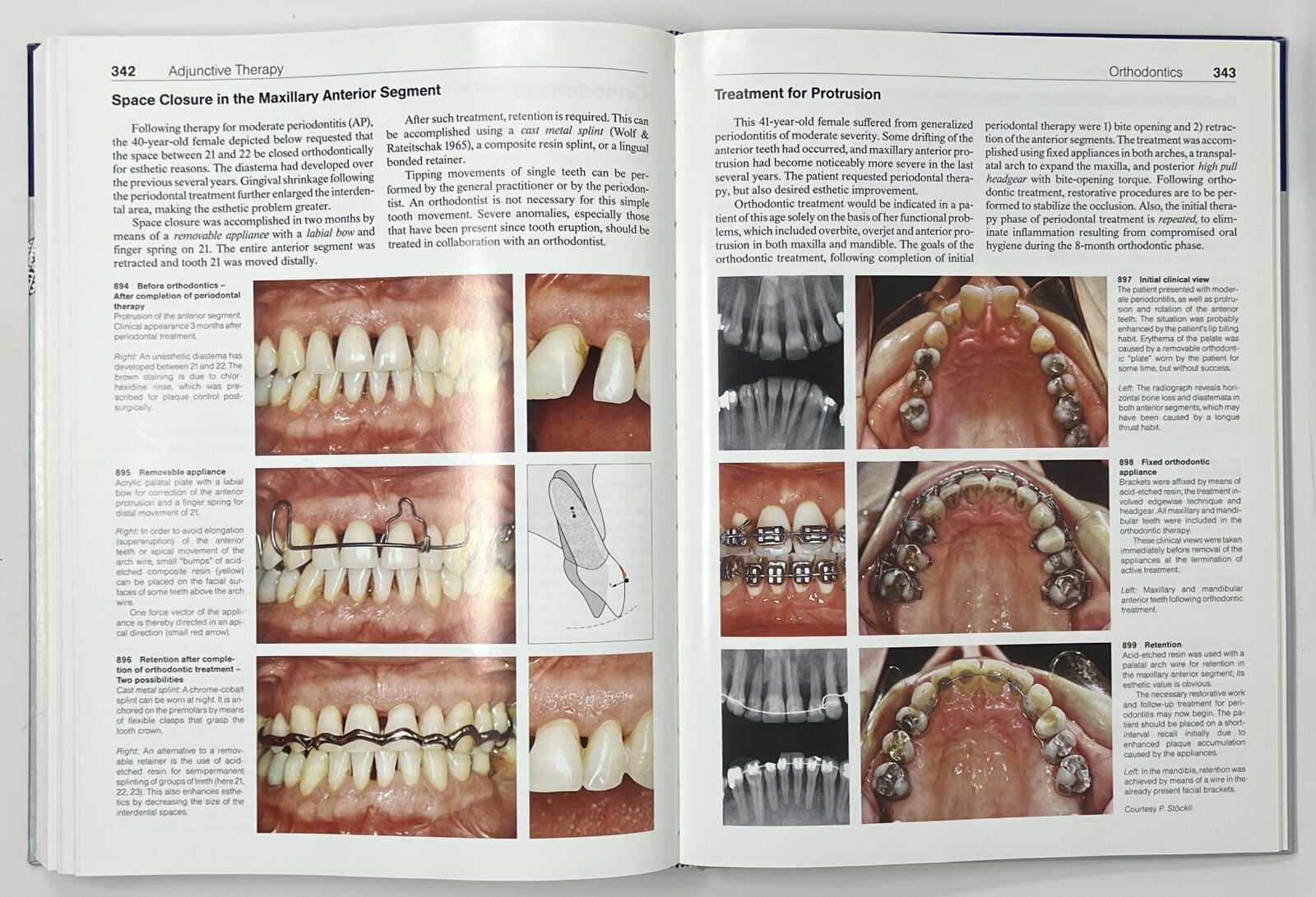 Color Atlas of Dental Medicine: Periodontology by Rateitschak, Wolf & Hassell HC