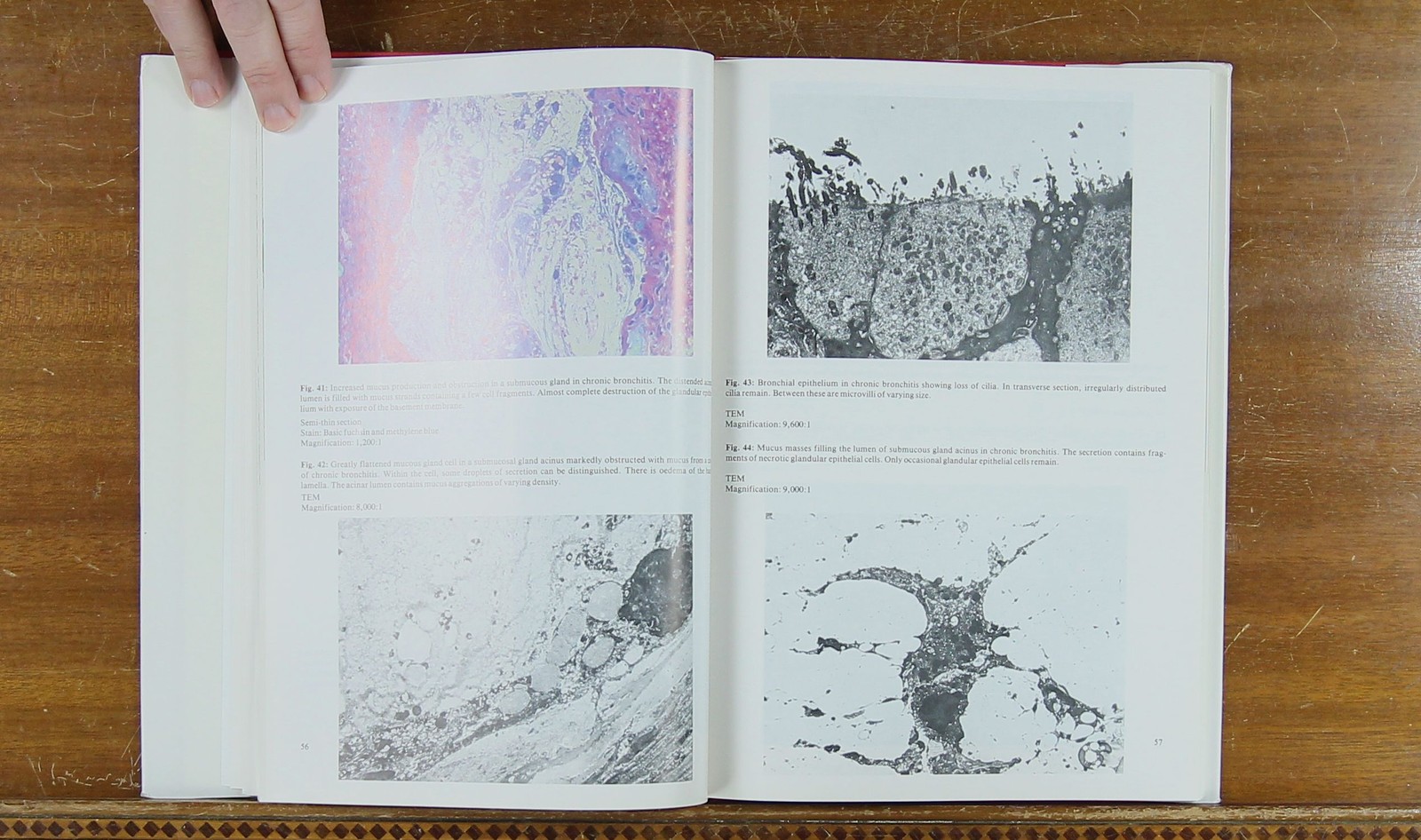 Atlas of Pulmonary Pathology 3885810212 Morgenroth, Newhouse, Nolte 1982