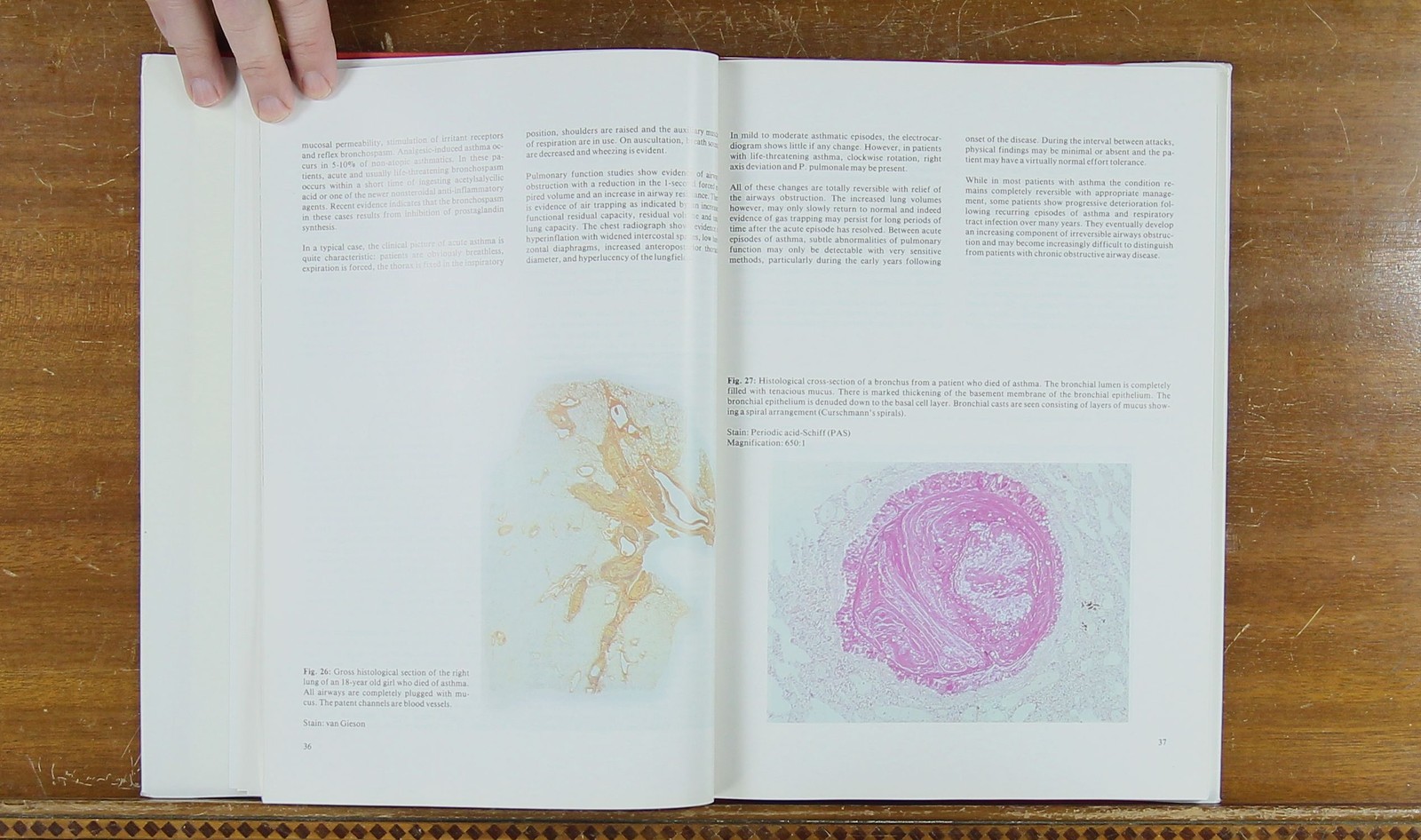 Atlas of Pulmonary Pathology 3885810212 Morgenroth, Newhouse, Nolte 1982