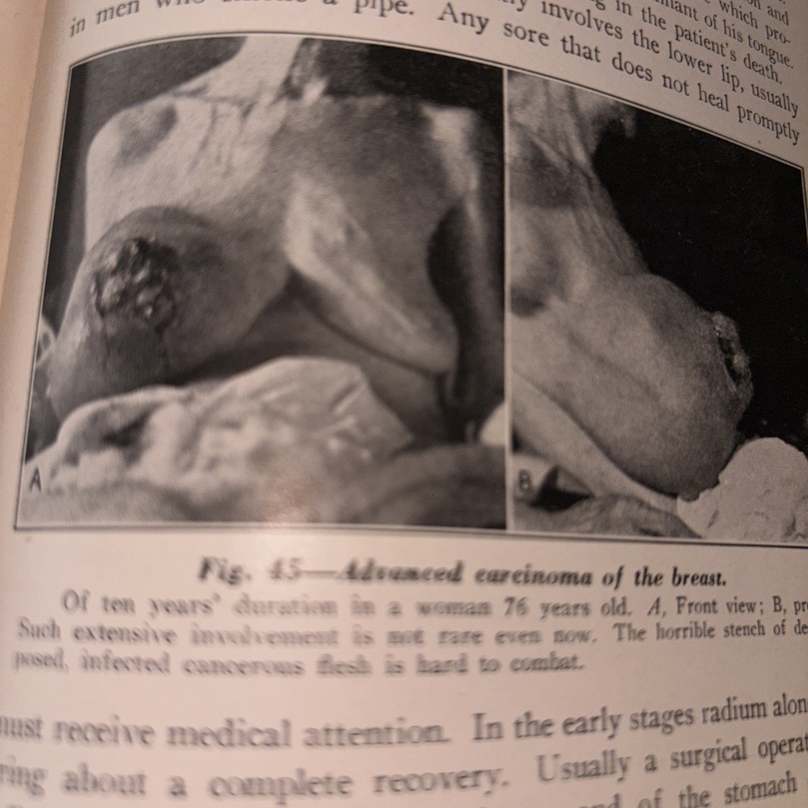 Text Book of pathology 1945, 5th Edition, Illustrated