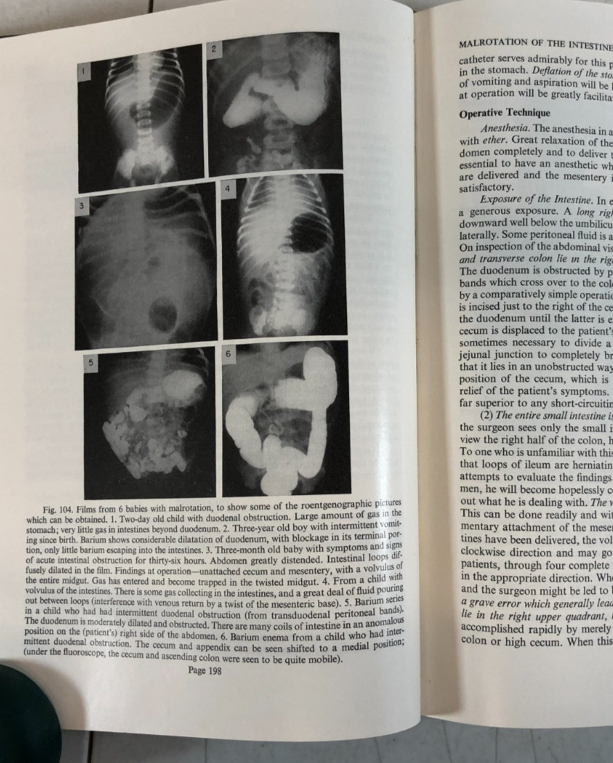 The Surgery of Infancy and Childhood, Gross, 1953, E-119