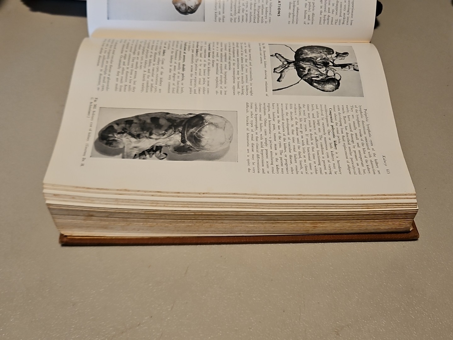 Pathology by W.A.D. Anderson 4th Edition HC Mosby 1961