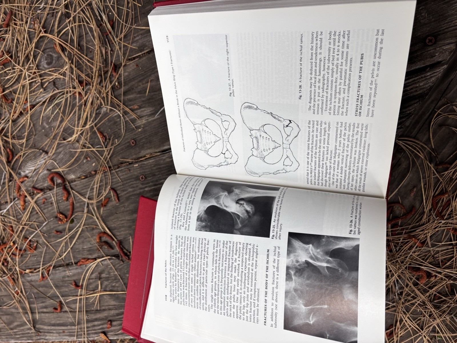 Rockwood Fractures in Adults & Children 2nd Ed Complete 3 Vol Set HC Orthopedic