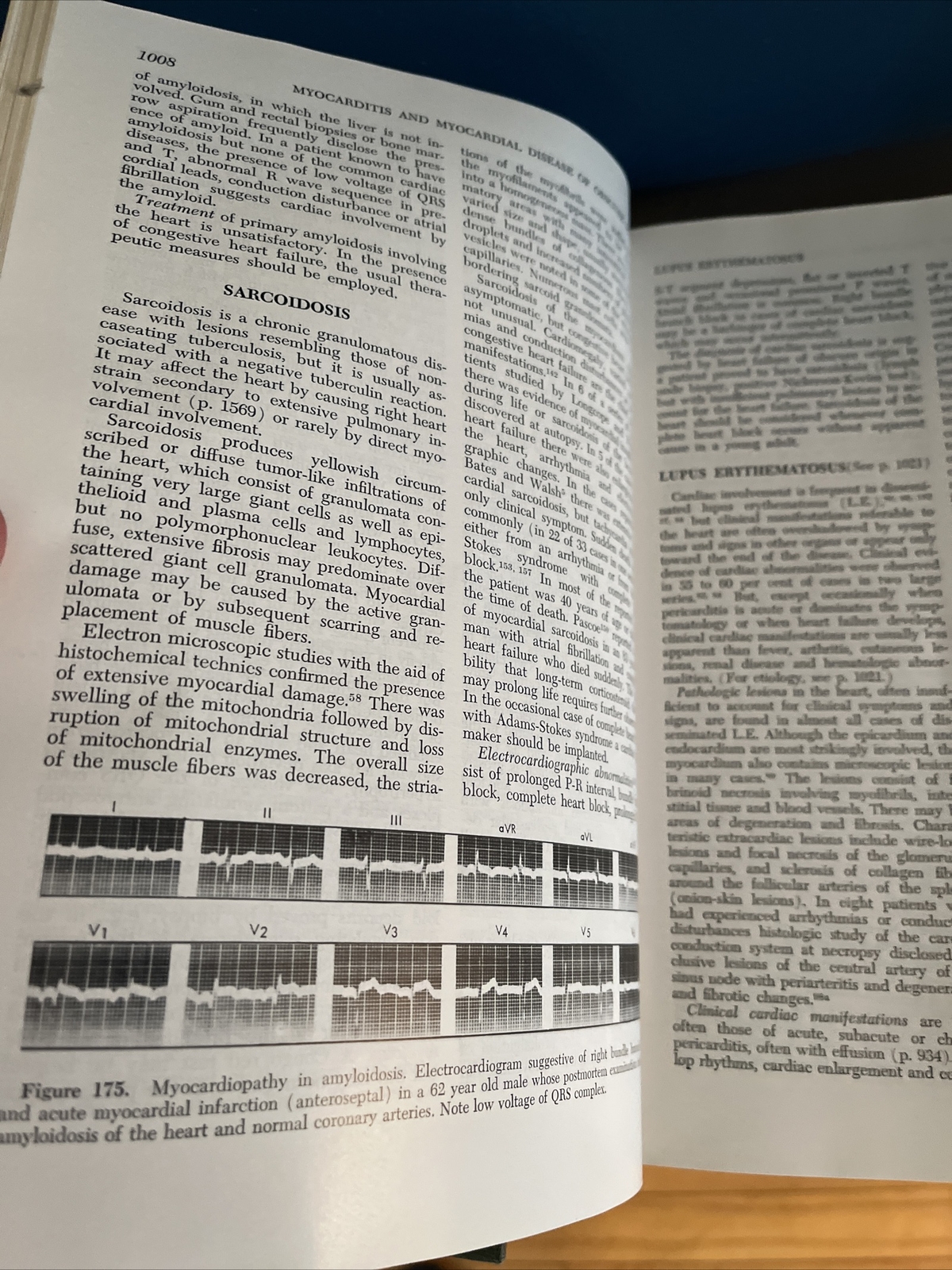 Diseases of the Heart by Friedberg, Charles K. 1966 HC Vol 1 & 2, Third Edition